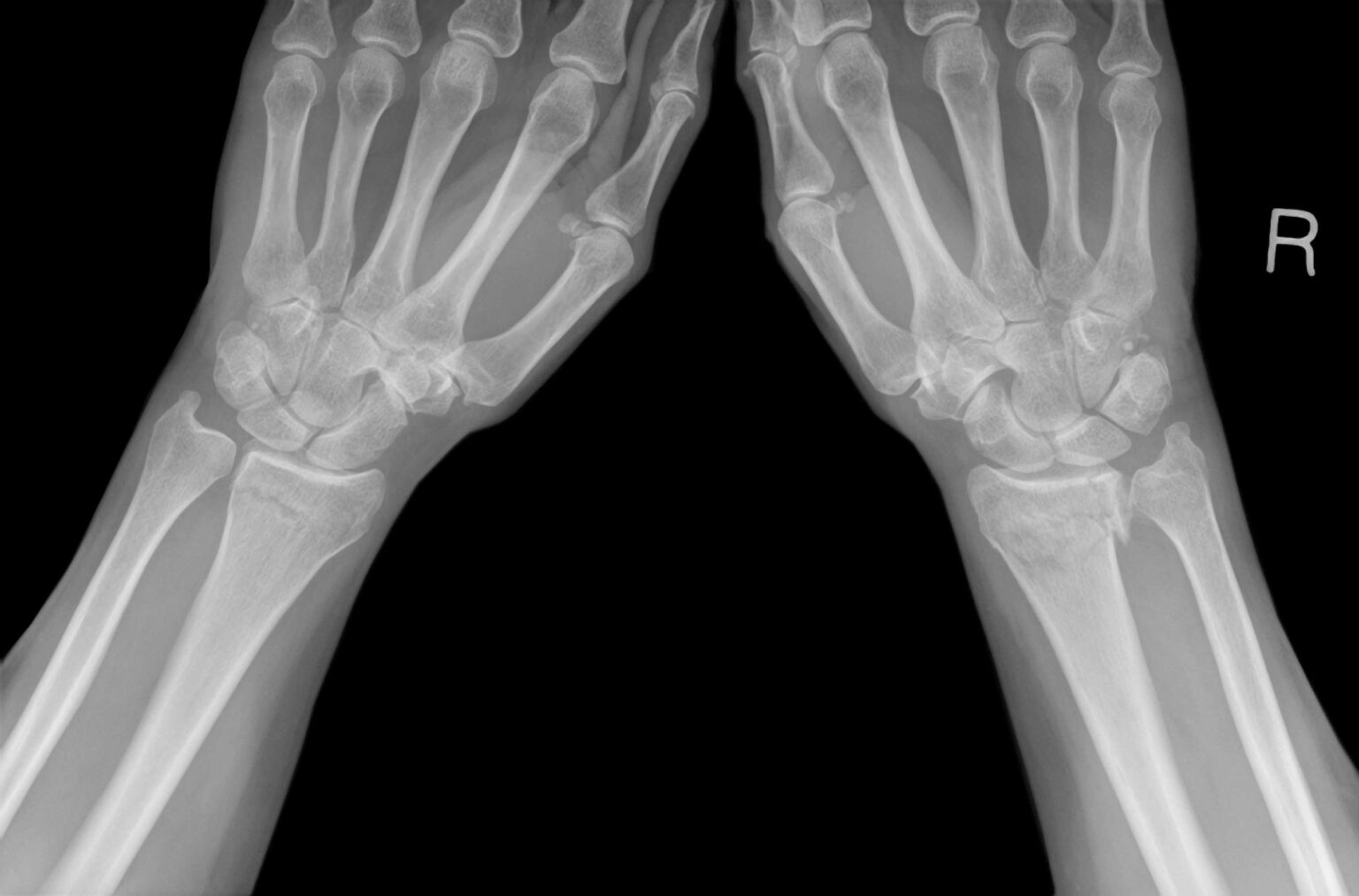 wrist fracture